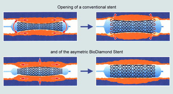 biodiamond_opening_stent